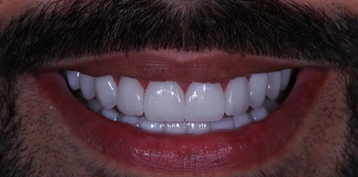 Facetas estéticas, resultado