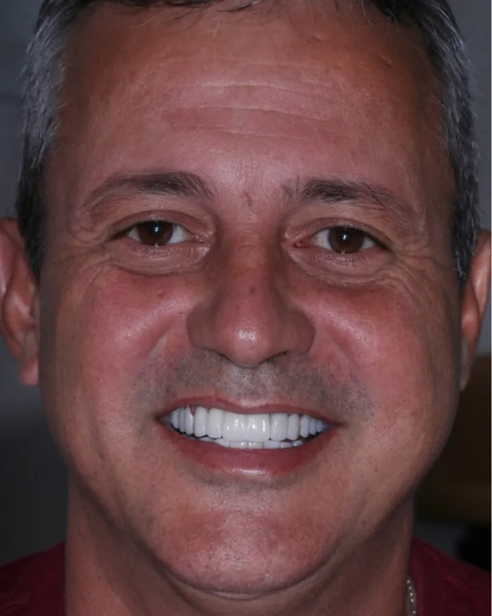 Clareamento dental, resultado